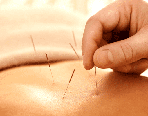 Pain and Acupuncture